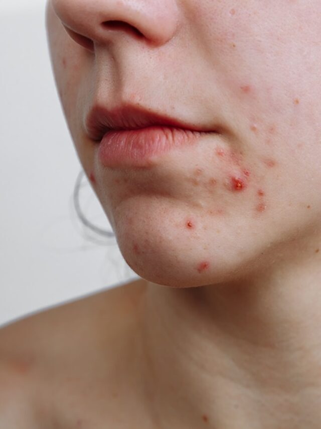cropped-young-women-with-problematic-skin-and-pimples-on-h-2022-01-12-16-51-47-utc.jpg