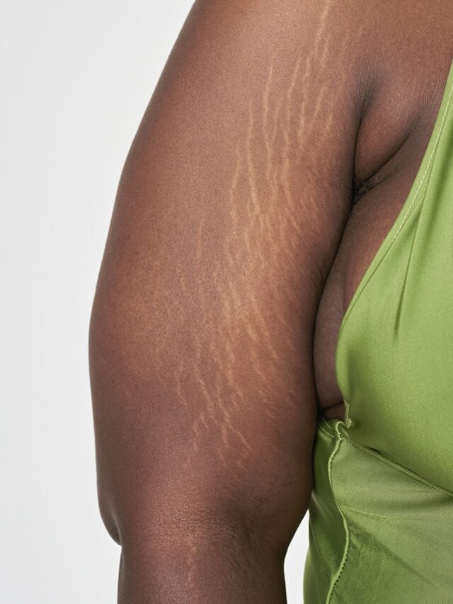 cropped-plus-size-woman-arm-s-white-stretch-mark-body-posi-2022-02-05-11-01-34-utc.jpg