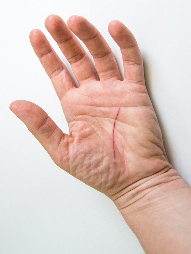 cropped-hand-with-a-scar-on-white-background-2022-02-13-17-49-56-utc.jpg